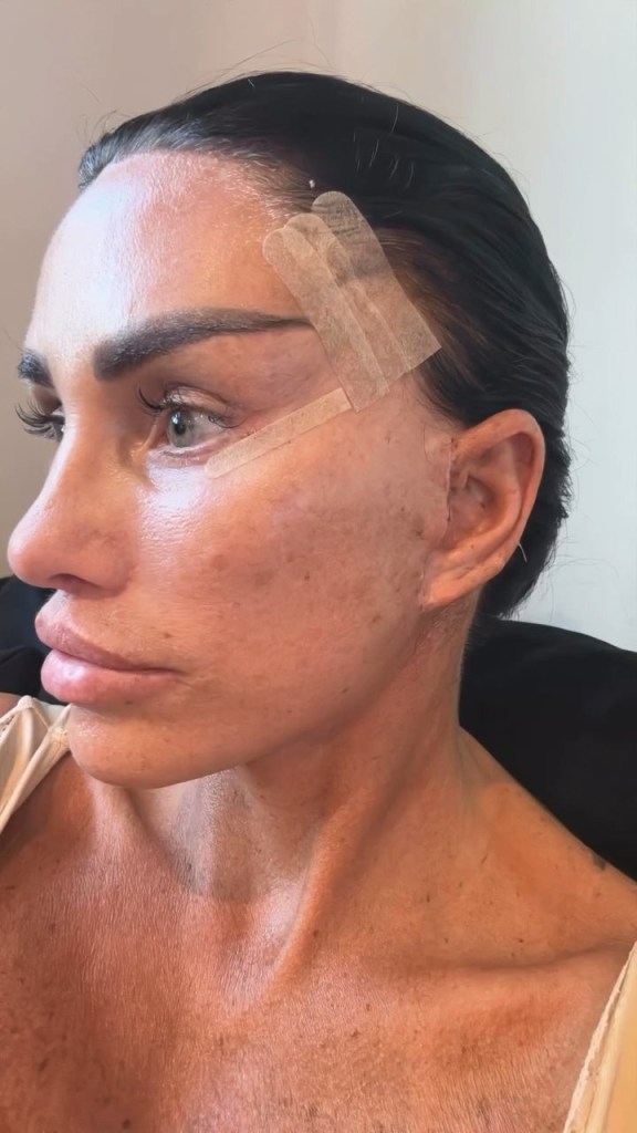 Katie Price looks away from the camera to reveal the results of a recent facelift