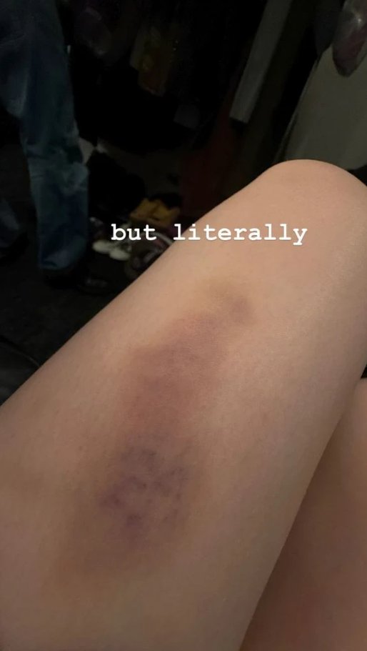 Billie Eilish shares photo of injury with fans after dramatic stage fall